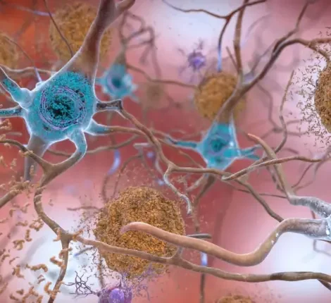 This rendering depicts the accumulation of amyloid plaques near the neurons of the brain. (National Institute on Aging, NIH.)