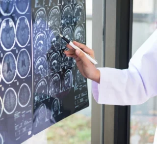 stroke-survivor Doctor pointing at brain scans